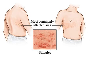 Shingles rash in band on front and back of right side of torso, with detail of shingles.