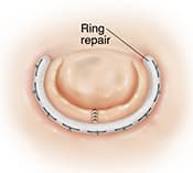 Top view of heart valve with C-shaped ring sutured around valve for repair.