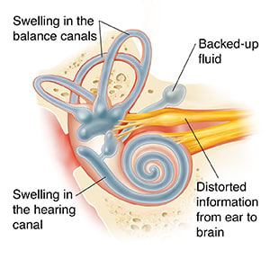 Cross section of ear showing cochlea with Meniere's disease.