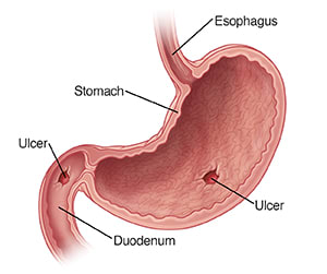 Cross section of stomach showing ulcers in stomach and duodenum.