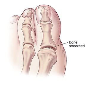 Top view of big toe showing joint after bone smoothed.