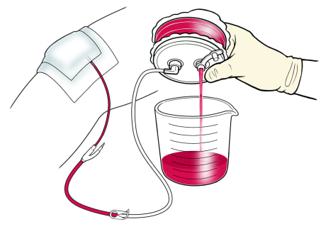 Closeup of gloved hand emptying fluid from hemovac drain into measuring container.