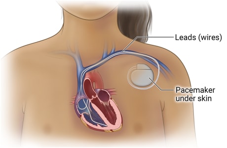 Pacemaker under skin below collarbone with wires going from device, through blood vessel, and into heart.