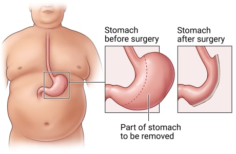 Location of stomach in belly, with detail of stomach before surgery showing the part to be removed compared with stomach after surgery.