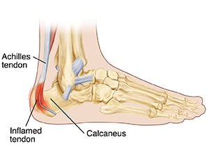 Side view of foot showing bones and inflamed Achilles tendon.