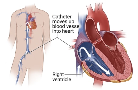 Catheter’s path through blood vessel from groin to heart, with detail of placement in right ventricle.
