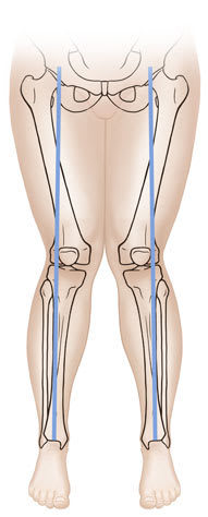 Front view child's legs showing bones with knock-knees.