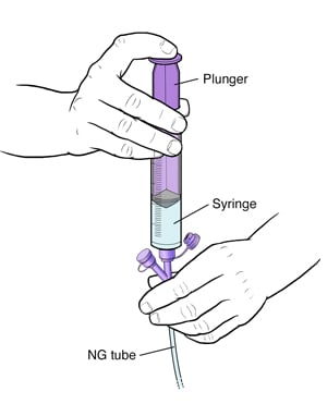 Closeup of hand NG tube with syringe inserted in port. Other hand is pressing down plunger on syringe.